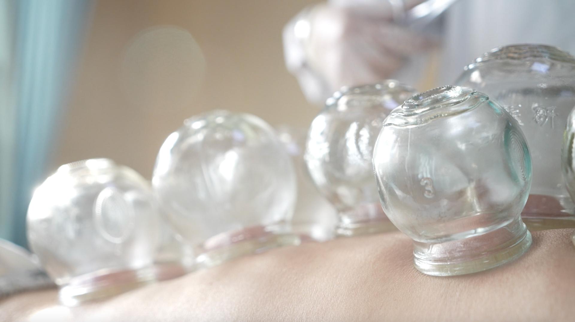 'Global Watch' editor observes TCM cupping therapy session in Beijing ...