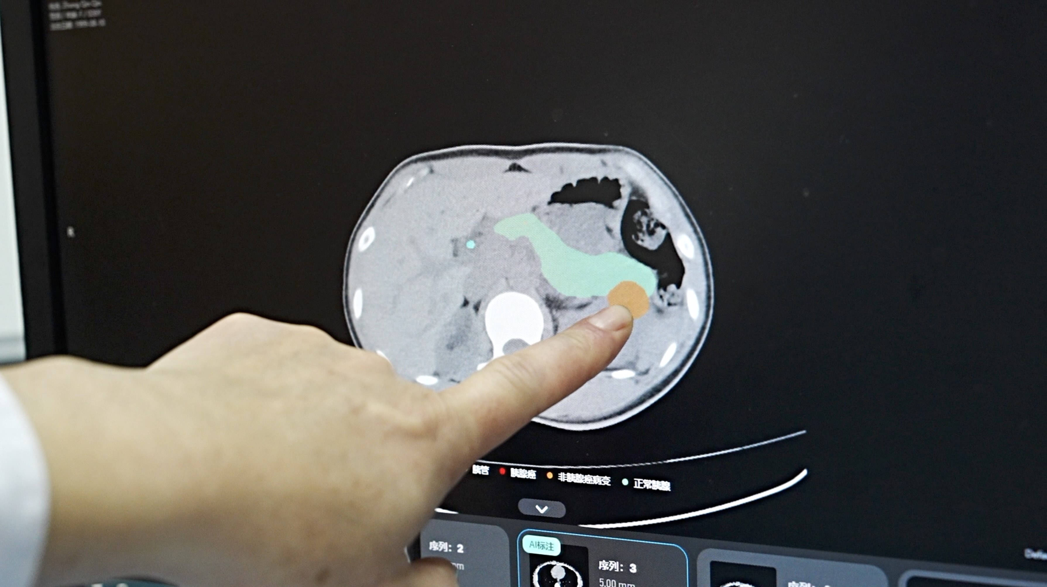 How Chinese AI is rewriting the rules of pancreatic cancer detection